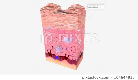 The Accumulation of keratinized cells 104644933