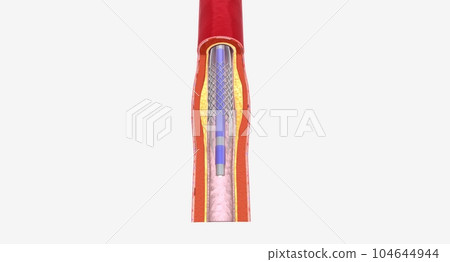Fat layer accumulating in arteries Fat layer accumulating in arteries 104644944