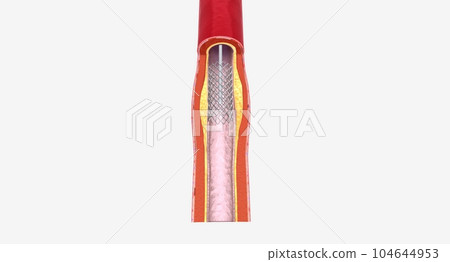 Fat layer accumulating in arteries Fat layer accumulating in arteries 104644953