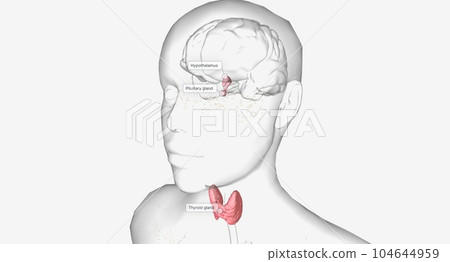 Hyperthyroidism is an overproduction of thyroid hormones Hyperthyroidism is an overproduction of thyroid hormones 104644959