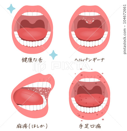 舌頭問題、疾病、麻疹、皰疹性咽峽炎、手足口病的插圖 104672661