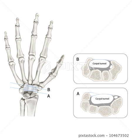 Medical illustration explaining carpal tunnel 104673502