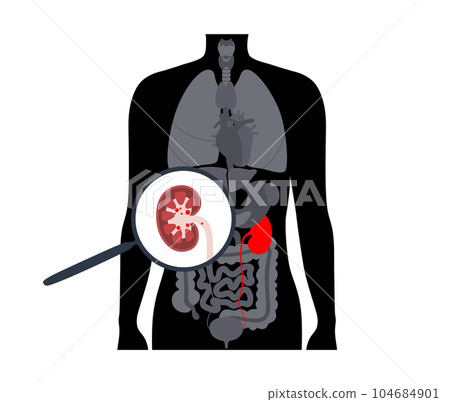 Kidney stones treatment Kidney stones treatment 104684901