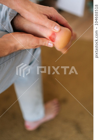 Close up vertical cropped shot of unrecognizable man holding foot with a blister on his heel. Male suffering from pain due to callus on heel of foot. Painful wound on mans feet caused by shoes. 104688518