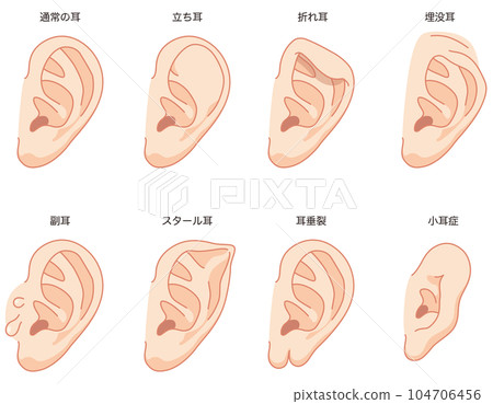 Ear deformation Ear formation medical care 104706456