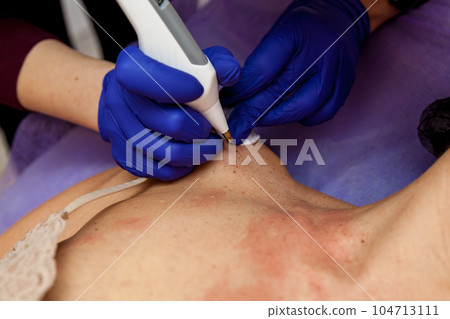 Removal of papillomas on the body 104713111