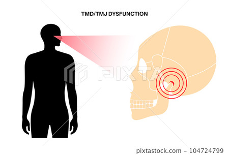 TMD TMJ disorder 104724799