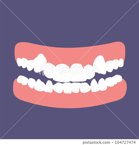 Orthodontic teeth problem crowding. Abnormal eruption. Double tooth. Opposite occlusion, open bite, crowded teeth, cavities, dentition. Vector illustration Orthodontic teeth problem crowding. Abnormal eruption. Double tooth. Opposite occlusion, open bite, crowded teeth, cavities, dentition. Vector illustration 104727474