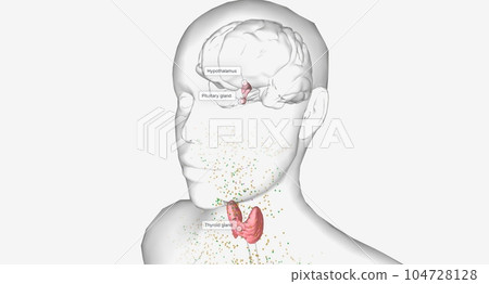 Hyperthyroidism is an overproduction of thyroid hormones 104728128