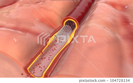 The Post Operative Intracranial Stent The Post Operative Intracranial Stent 104728134