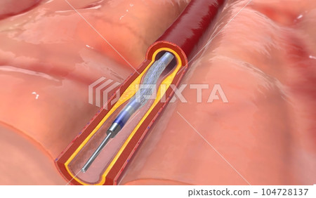 If the artery occlusion is in the brain, the surgery is called i If the artery occlusion is in the brain, the surgery is called i 104728137