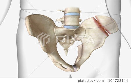 Pelvic fractures are classified as stable or unstable 104728144