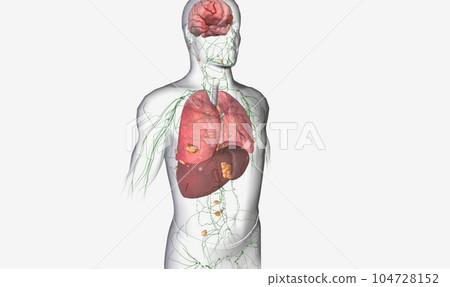 Melanoma Stage IV Distant Metastasis Melanoma Stage IV Distant Metastasis 104728152
