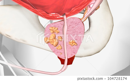 The Stage III Prostate Cancer The Stage III Prostate Cancer 104728174