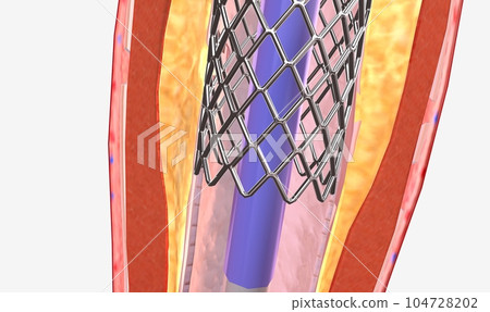 The balloon expends, widening the wire mesh stent and the artery 104728202