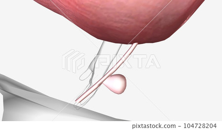 A urethral diverticulum is a rare condition in which a sac or ou A urethral diverticulum is a rare condition in which a sac or ou 104728204
