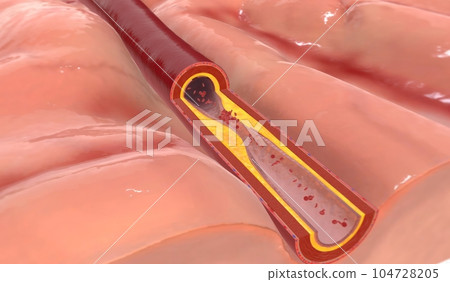 Fat deposits within the artery can build up at the injury site a Fat deposits within the artery can build up at the injury site a 104728205