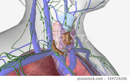 In stage IV thyroid cancer, the tumor has grown beyond the thyro In stage IV thyroid cancer, the tumor has grown beyond the thyro 104728206