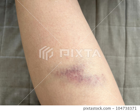 大腿瘀傷的特寫 大腿瘀傷的特寫 104738371