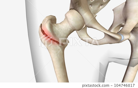 A pertrochanteric fracture is a hip fracture that is found in the trochanteric region of the femur 104746817