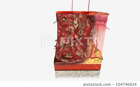 Pyoderma Gangrenosum Stage III3d Pyoderma Gangrenosum Stage III3d 104746834