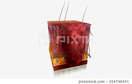 Necrotizing Fasciitis in Skin Tissue Necrotizing Fasciitis in Skin Tissue 104746841
