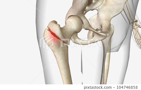A pertrochanteric fracture is a hip fracture that is found in the trochanteric region of the femur 104746858