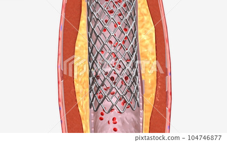 Stent insertion into artery narrowed from plaque 104746877