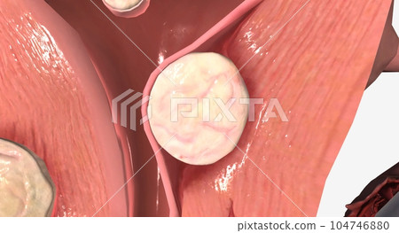 Uterine fibroids are benign growths of tissue in the uterus. 104746880