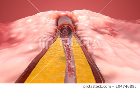 Hypercholesterolemia is a condition characterized by higher than 104746883