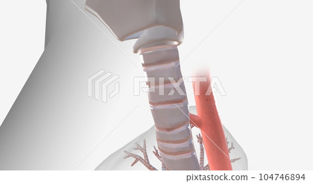A tracheoesophageal fistula is an abnormal connection between the trachea (windpipe) and the esophagus. A tracheoesophageal fistula is an abnormal connection between the trachea (windpipe) and the esophagus. 104746894