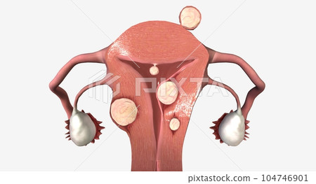 Uterine fibroids are benign growths of tissue in the uterus. 104746901