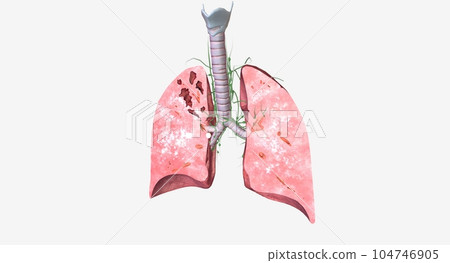 The Tuberculosis EarlyIntermediate in Lungs The Tuberculosis EarlyIntermediate in Lungs 104746905