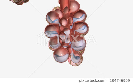 Pulmonary edema is a condition caused by too much fluid in the lungs. 104746909