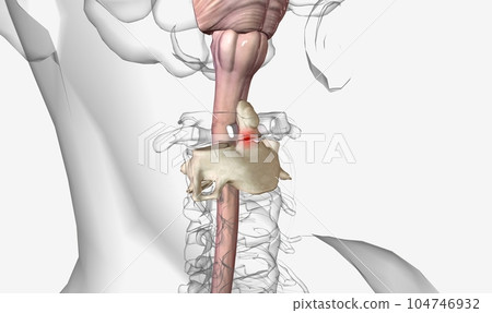Odontoid (dens) fractures refer to the second cervical vertebra 104746932