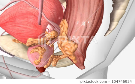 The Stage IV Prostate Cancer The Stage IV Prostate Cancer 104746934