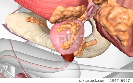 The Stage IV Prostate Cancer The Stage IV Prostate Cancer 104746937