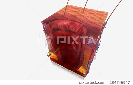 Necrotizing Fasciitis in Skin Tissue Necrotizing Fasciitis in Skin Tissue 104746947