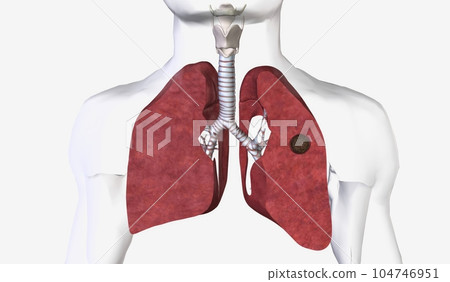Pulmonary aspergilloma is a mass caused by a fungal infection th Pulmonary aspergilloma is a mass caused by a fungal infection th 104746951