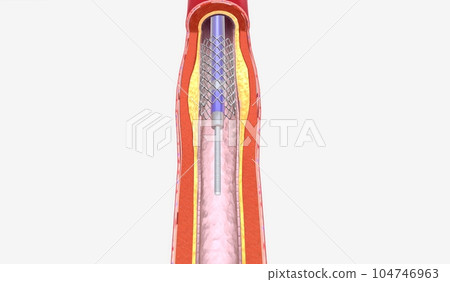 Stent insertion into artery narrowed from plaque Stent insertion into artery narrowed from plaque 104746963