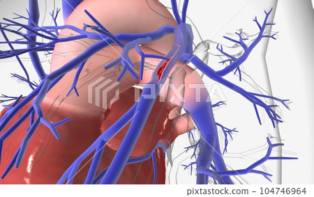 A pulmonary embolism is a sudden blockage in your pulmonary arteries, the blood vessels that send blood to your lungs A pulmonary embolism is a sudden blockage in your pulmonary arteries, the blood vessels that send blood to your lungs 104746964