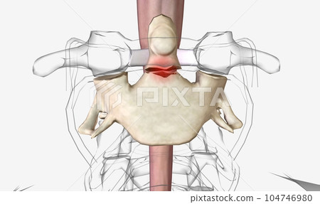 Odontoid (dens) fractures refer to the second cervical vertebra Odontoid (dens) fractures refer to the second cervical vertebra 104746980