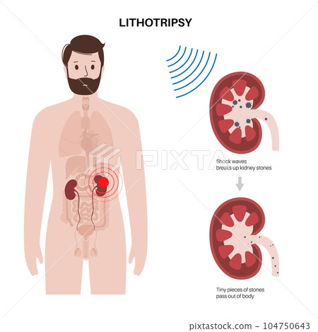 Lithotripsy procedure concept 104750643