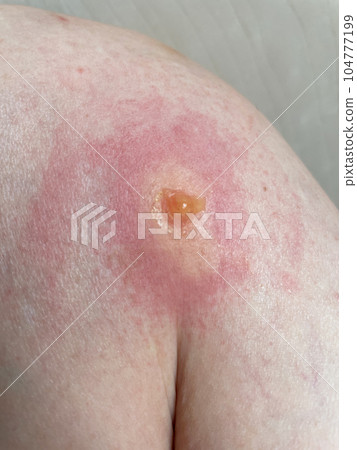 蚊蟲叮咬後起的水泡 蚊蟲叮咬後起的水泡 104777199