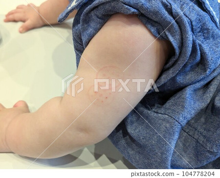 Baby's arm on the day of BCG injection Baby's arm on the day of BCG injection 104778204