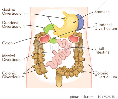 憩室、梅克爾憩室、小腸 憩室、梅克爾憩室、小腸 104792010