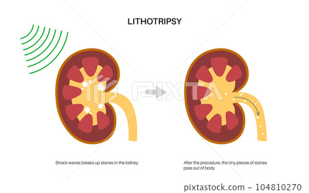 Lithotripsy procedure concept Lithotripsy procedure concept 104810270