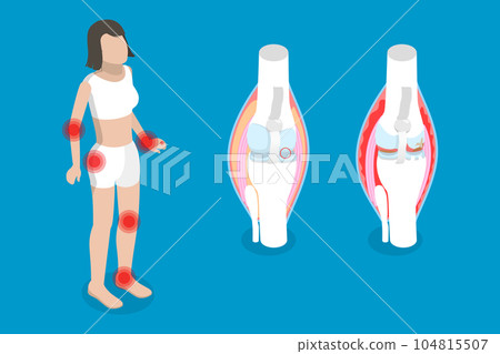 3D Isometric Flat Vector Conceptual Illustration of Rheumatism 3D Isometric Flat Vector Conceptual Illustration of Rheumatism 104815507