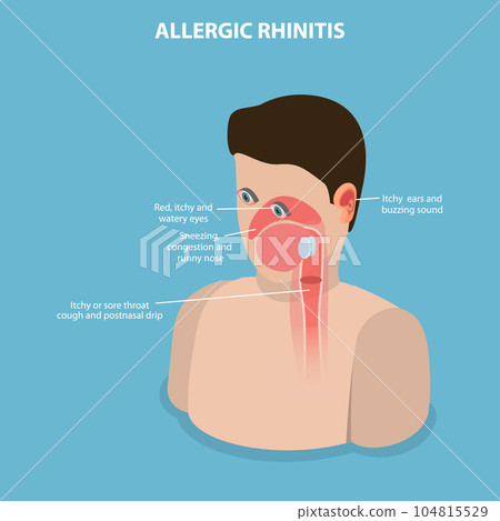 3D Isometric Flat Vector Conceptual Illustration of Allergic Rhinitis 3D Isometric Flat Vector Conceptual Illustration of Allergic Rhinitis 104815529