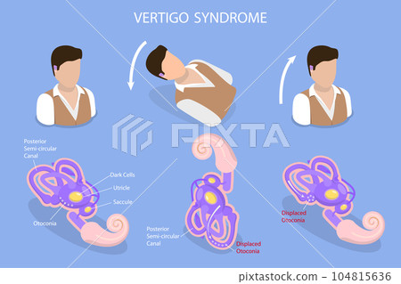 3D Isometric Flat Vector Conceptual Illustration of Vertigo Syndrome 104815636